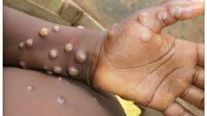 نحوه ابتلا و علائم بیماری ویروسی آبله میمون چیست؟ نحوه ابتلا و علائم بیماری ویروسی آبله میمون چیست؟
